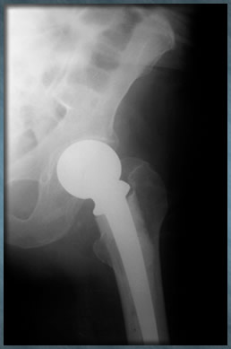 hip implant